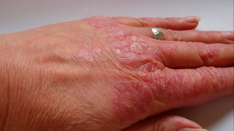 psoriasis symptomen op de handen