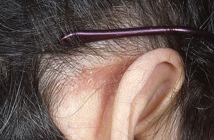 Psoriatische plaque achter het oor