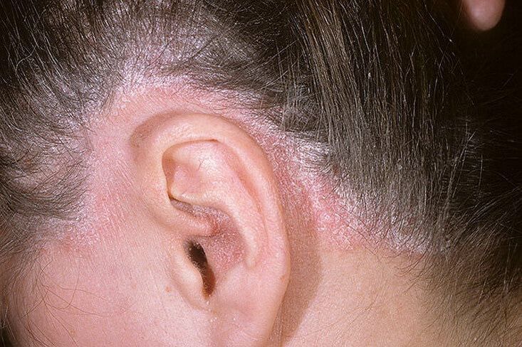 Uitbarstingen van psoriasis op het hoofd achter de oren