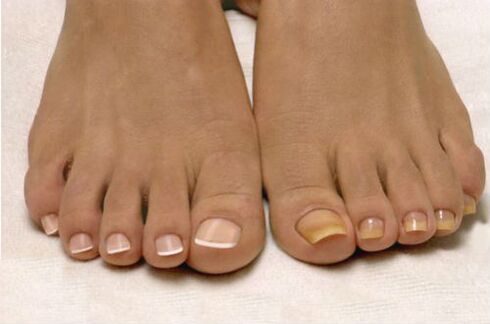 psoriasis op nagels