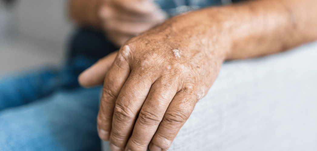 Psoriasis op de huid van de hand