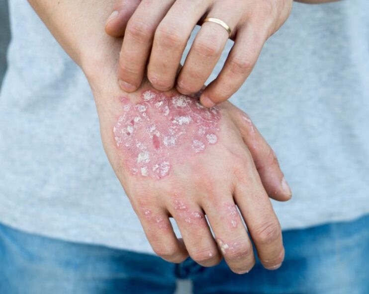 Psoriasis in de handen