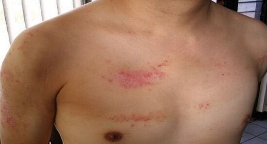 Psoriasis in het borstgebied
