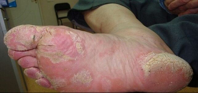 Psoriasis op de benen