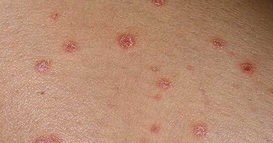 Psoriatic plaques