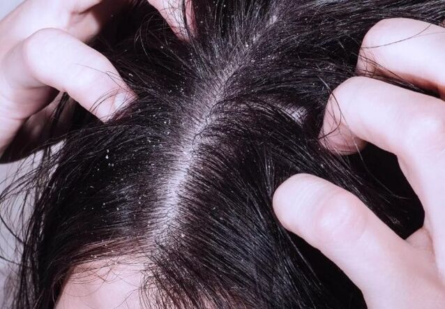 Psoriasis op het hoofd