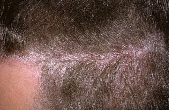 Psoriasis op het hoofd