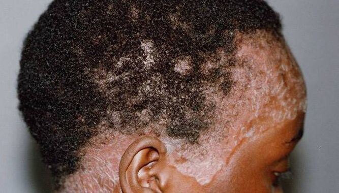 Psoriasis op het hoofd