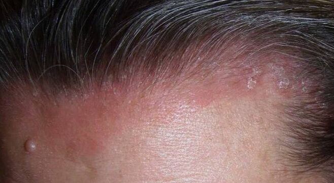 Wat is psoriasis