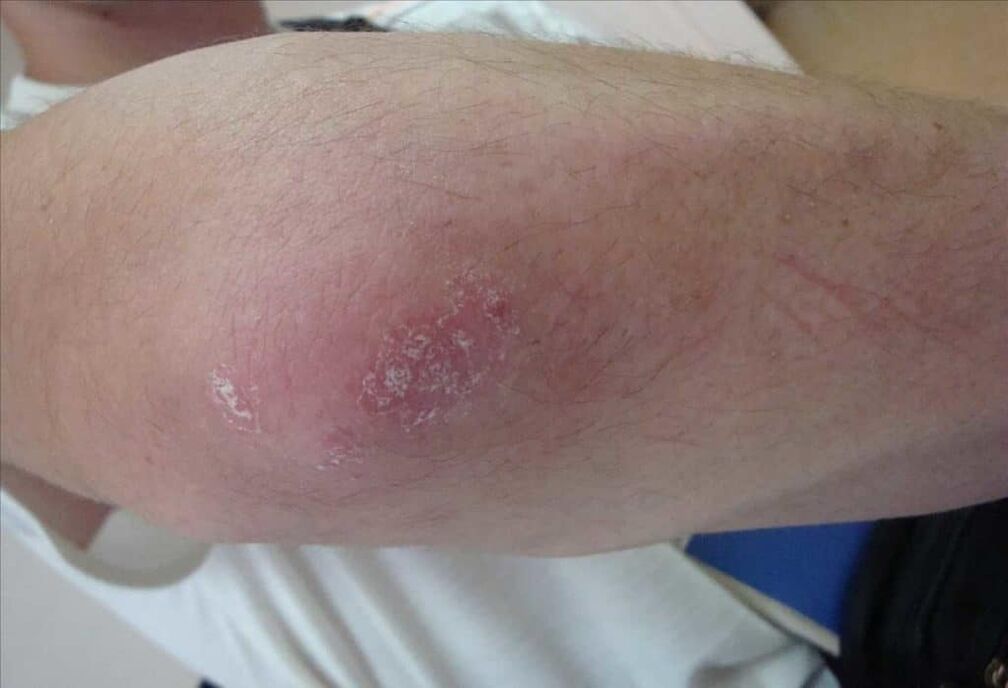 Hoe psoriasis eruit ziet