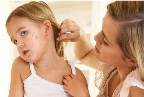 Psoriasis bij kinderen
