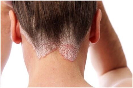 Psoriasis in het haar