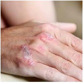 Psoriasis op de borstel