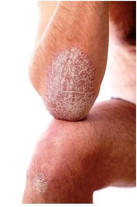 Psoriasis op de elleboog