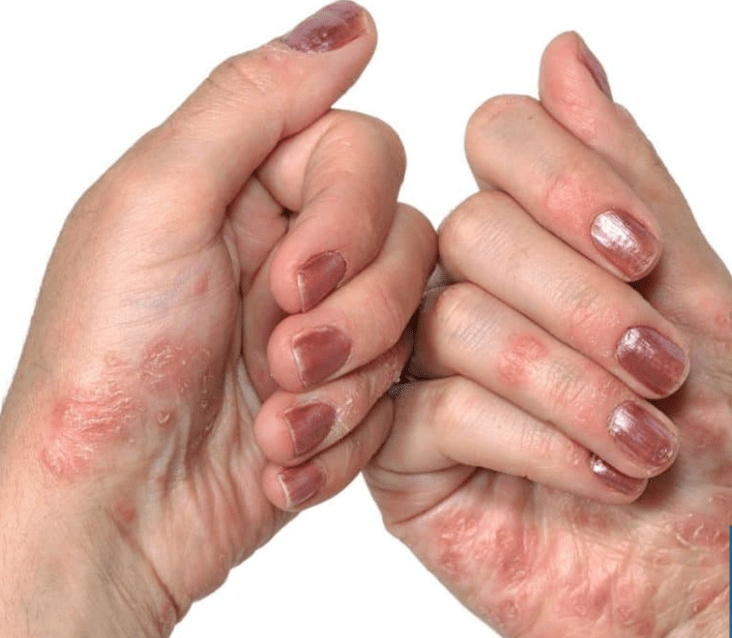 Psoriasis in de handen