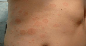Pech psoriasis