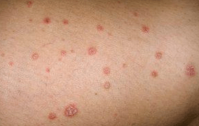 Psoriatic plaques