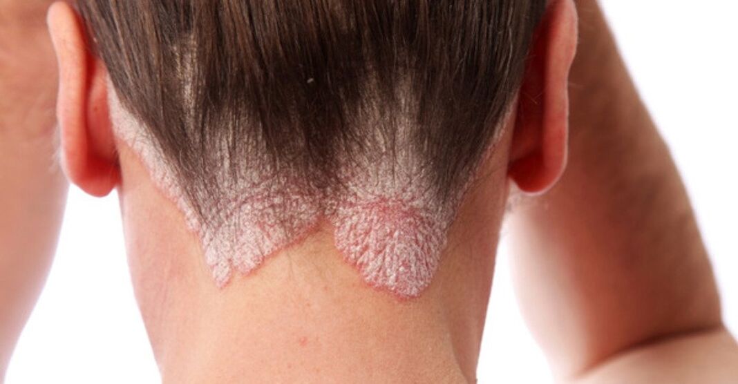 Psoriasis op het hoofd van meisjes