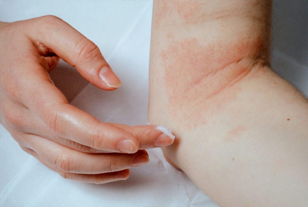 Behandeling van psoriasis