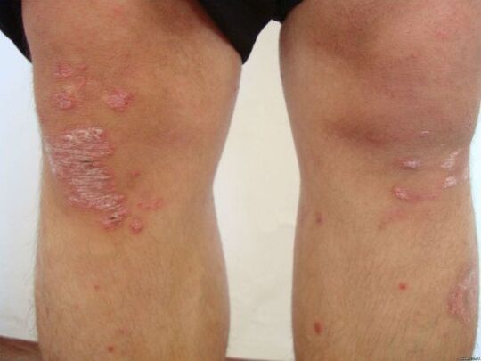 De oorzaken van psoriasis