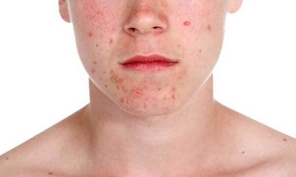 Symptomen van psoriasis