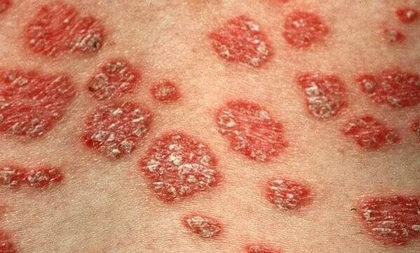 Vormen van psoriasis