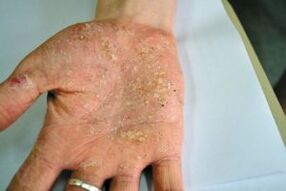 Psoriasis in de palm van je hand