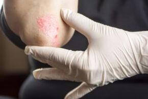 Psoriasis op de elleboog