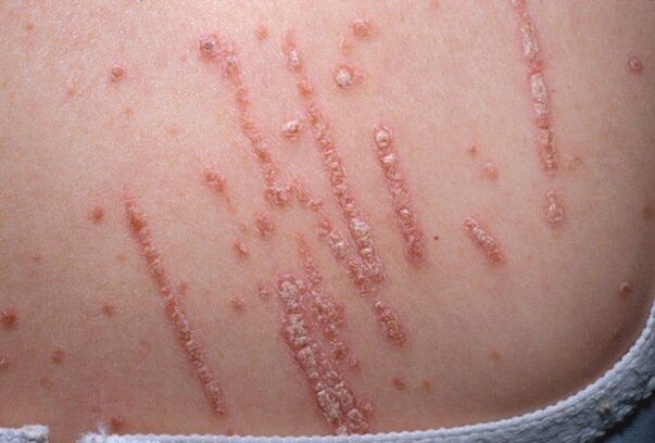 Psoriasis op het lichaam