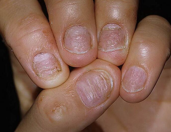Psoriasis van nagels