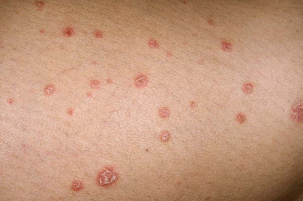 Psoriatische plaques