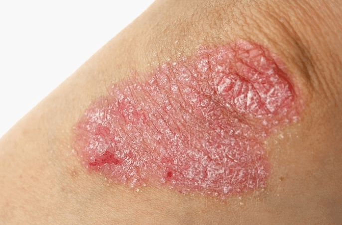 Progressieve fase van psoriasis