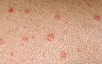 Psoriasis in het allereerste beginstadium