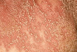 Pustuleuze psoriasis
