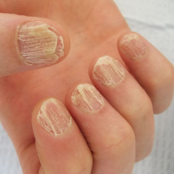 Nagelbeschadiging door psoriasis