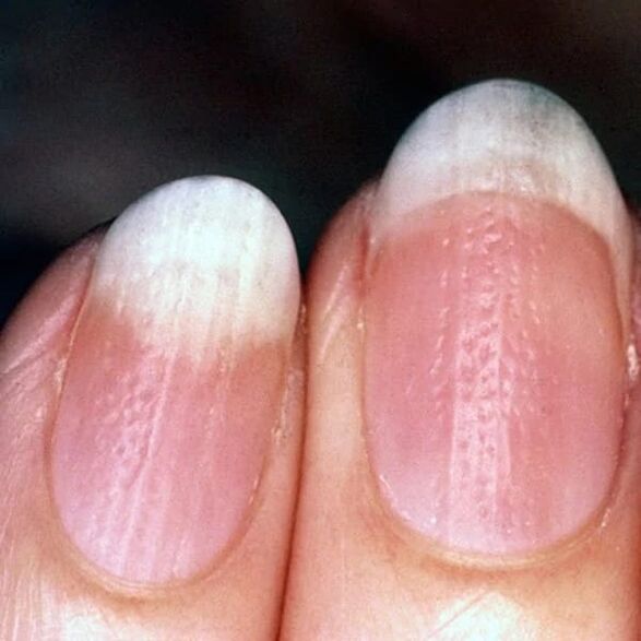 Nagelpsoriasis