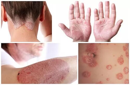 Manifestaties van psoriasis op verschillende delen van het lichaam