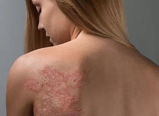Psoriasis op de rug van een meisje