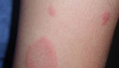 Hoe manifesteert de beginfase van psoriasis zich