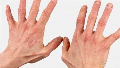 Hoe ziet de beginfase van psoriasis eruit