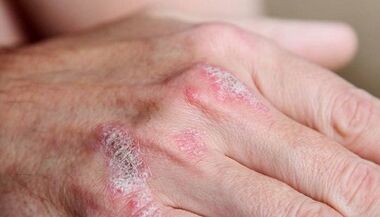 symptomen van de beginfase van psoriasis