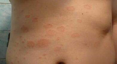 hoe u de beginfase van psoriasis kunt herkennen