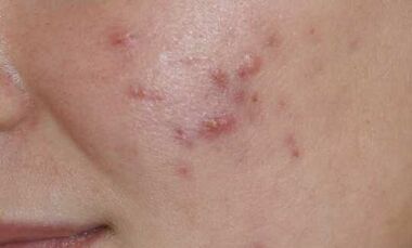 symptomen van de beginfase van psoriasis