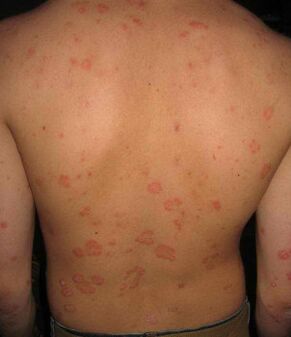 psoriasis op de rug