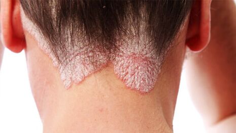 Psoriatische plaques op de hoofdhuid
