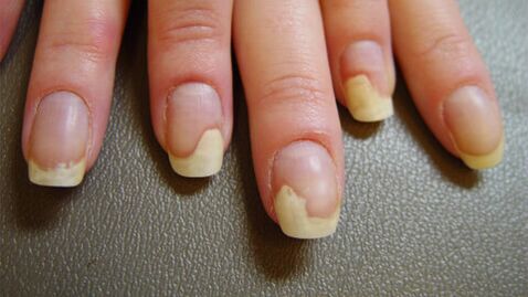 Witte vlekken op nagels als gevolg van psoriasis