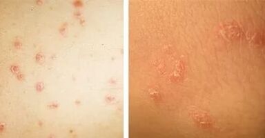 belangrijkste manifestaties van psoriasis