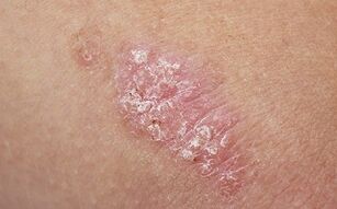 oorzaken van psoriasis