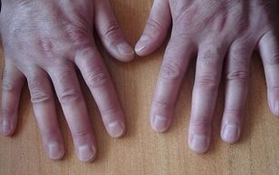 symptomen van psoriasis in de beginfase