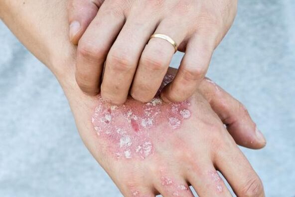 karakteristieke symptomen van psoriasis op de handen